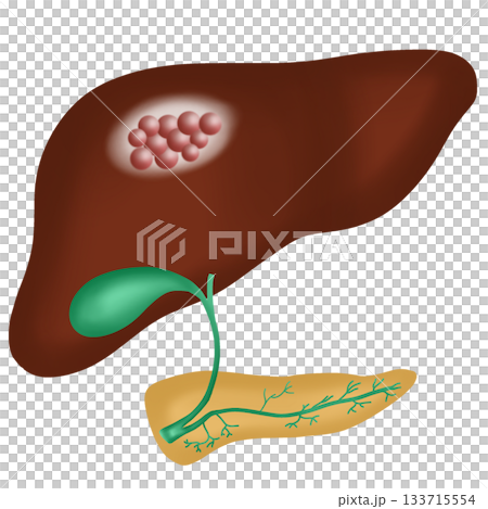 Liver Cancer or Hepatocellular Carcinoma, Malignant Tumor in Human Liver Diagram, hand drawn watercolor illustration 133715554