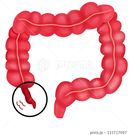 Appendicitis Disease, Inflamed Human Appendix and Colon Diagram 133717097