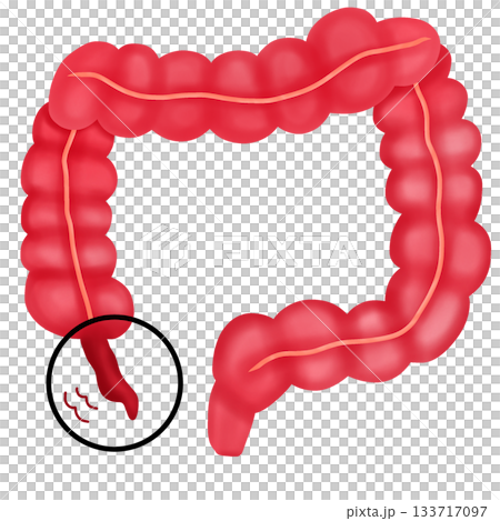 Appendicitis Disease, Inflamed Human Appendix and Colon Diagram 133717097
