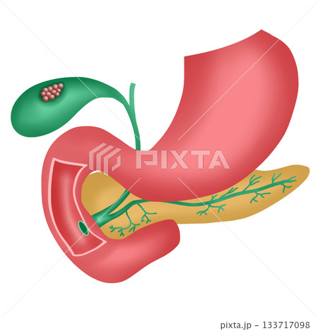 Gallbladder Cancer, Malignant Tumor in Human Gallbladder and Digestive System Diagram 133717098