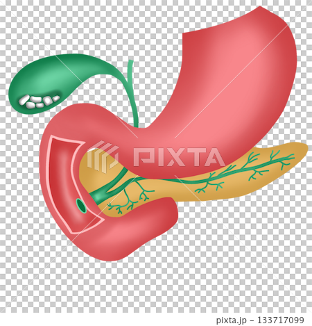 Gallstones or Cholelithiasis Disease, Stones in Human Gallbladder and Digestive System Diagram 133717099