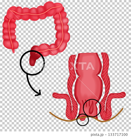 Internal and External Hemorrhoids in Rectum and Anus Internal and External Hemorrhoids in Rectum and Anus 133717100