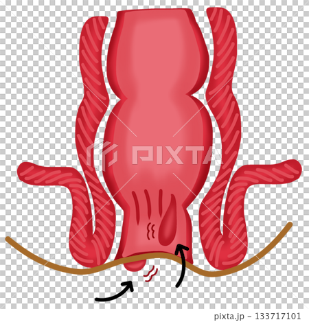 Hemorrhoids or Anal Fissure - Rectum and Anus Medical Condition Diagram, hand drawn watercolor illustration 133717101
