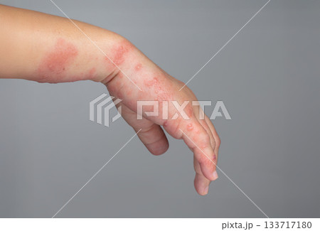 Shingles, Zoster or Herpes Zoster symptoms on arm. Shingles, Zoster or Herpes Zoster symptoms on arm. 133717180