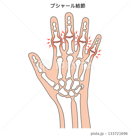 ブシャール結節　指の関節の病気 133721696