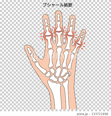 ブシャール結節　指の関節の病気 133721696