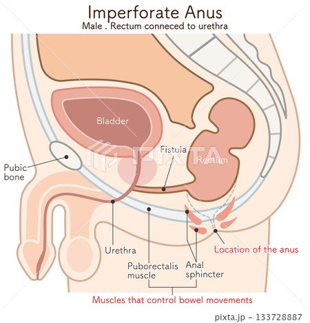 男性の鎖肛_直腸尿道ろう_imperforate anus(ARM) illustration 男性の鎖肛_直腸尿道ろう_imperforate anus(ARM) illustration 133728887