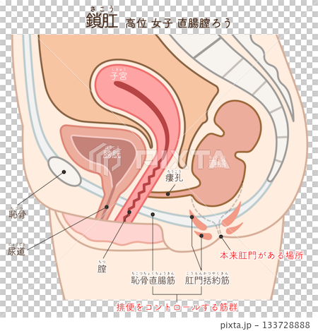 Female imperforate anus (ARM) illustration 133728888