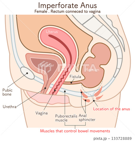 女性の鎖肛_直腸膣ろう_imperforate anus(ARM) illustration 女性の鎖肛_直腸膣ろう_imperforate anus(ARM) illustration 133728889