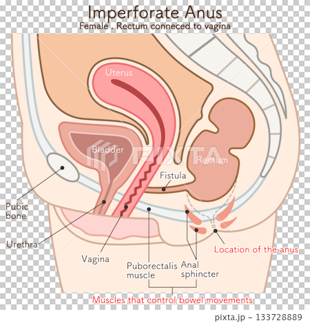 女性の鎖肛_直腸膣ろう_imperforate anus(ARM) illustration 女性の鎖肛_直腸膣ろう_imperforate anus(ARM) illustration 133728889