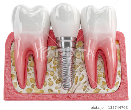 Dental implant, artificial tooth roots into jaw isolated on white background PNG transparent clipart. 133744768