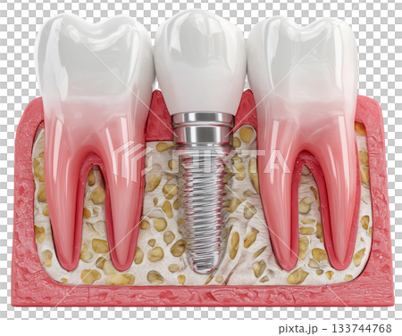 Dental implant, artificial tooth roots into jaw isolated on white background PNG transparent clipart. 133744768