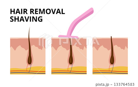 Hair follicle before, during and after shaving with razor blade 133764583
