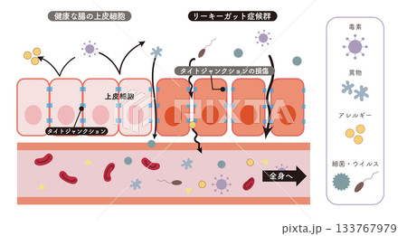 小腸の上皮細胞の断面イラストとリーキーガット症候群をわかりやすく表したイラスト 133767979