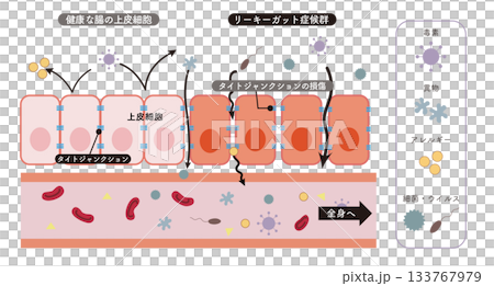 小腸の上皮細胞の断面イラストとリーキーガット症候群をわかりやすく表したイラスト 133767979