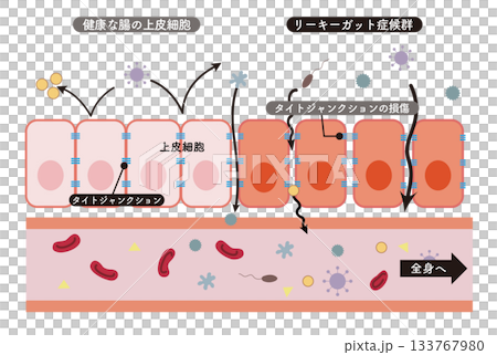 小腸上皮細胞橫切面示意圖與腸漏症候群的簡明易懂示意圖 133767980