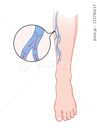 Varicose veins. Blue blood vessel visible through the skin, abnormally swollen leg. Vascular disease diagnostic and treatment. Venous insufficiency medical disease Varicose veins. Blue blood vessel visible through the skin, abnormally swollen leg. Vascular disease diagnostic and treatment. Venous insufficiency medical disease 133780217