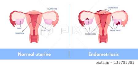 Endometriosis. Female uterus endometrium, infertility fertility womb reproductive system dysmenorrhea adenomyosis cyst cancer medical education poster, neat vector illustration 133783383