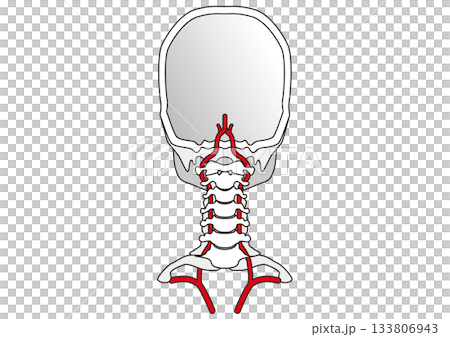 椎骨動脈 鎖骨下動脈 頸椎の横突孔 脳梗塞やくも膜下出血の原因 椎骨動脈 鎖骨下動脈 頸椎の横突孔 脳梗塞やくも膜下出血の原因 133806943
