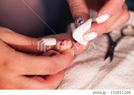 Nail care session focusing on cleaning and tidying toes in a wellness salon during a relaxing afternoon. A festering finger with an ingrown nail. Nail care session focusing on cleaning and tidying toes in a wellness salon during a relaxing afternoon. A festering finger with an ingrown nail. 133811109