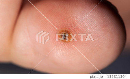 Macro View Of Plantar Wart On Toe. A Close-Up Shot Shows A Verruca Caused By Human Papillomavirus. Macro View Of Plantar Wart On Toe. A Close-Up Shot Shows A Verruca Caused By Human Papillomavirus. 133811304
