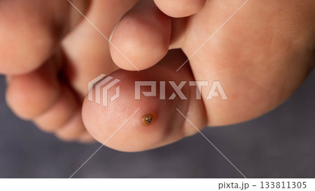Foot ailment shows a small bump on the toe during close-up examination in a clinical setting 133811305