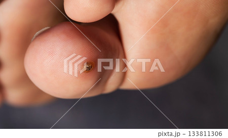 Direct Overhead View Of A Toe Wart. This Macro Image Displays The Verruca's Structure. 133811306