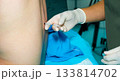 Anesthesiologist's hands holding an epidural anesthesia needle. 133814702