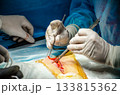 The surgeon operates on a patient with surgical instruments. 133815362