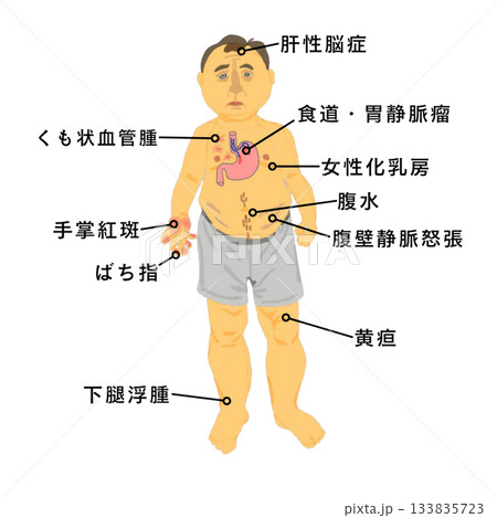 肝硬変の全身症状イラスト｜黄疸・腹水・くも状血管腫など看護学生向け医療教材 133835723