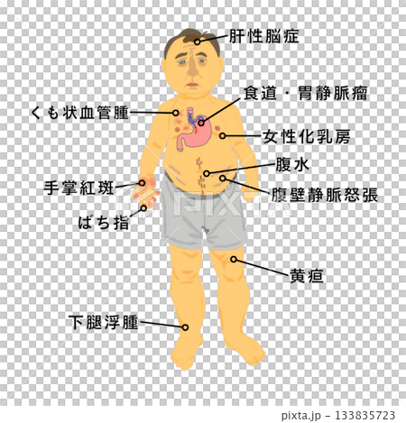 肝硬変の全身症状イラスト｜黄疸・腹水・くも状血管腫など看護学生向け医療教材 133835723