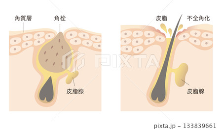毛穴詰まりと皮脂 133839661