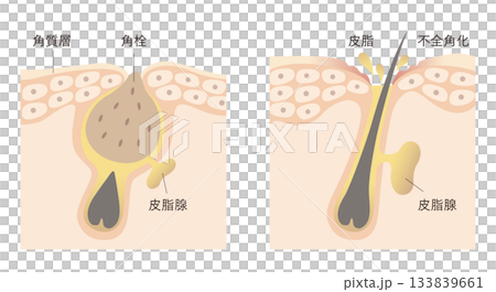 毛穴詰まりと皮脂 133839661