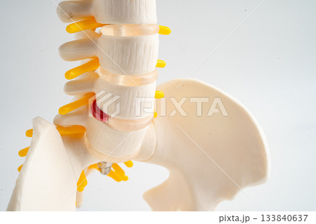 Lumbar spine displaced herniated disc fragment, spinal nerve and bone. Model for treatment medical in the orthopedic department. Lumbar spine displaced herniated disc fragment, spinal nerve and bone. Model for treatment medical in the orthopedic department. 133840637