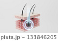 レーザーが毛根をターゲットに破壊する医療脱毛CGイラスト 133846205
