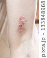 Woman with shingles on the skin she feels very painful 133848968