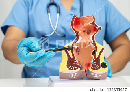 Asian doctor with rectum and hemorrhoid human anatomy model at hospital, inflamed vascular structure. 133855937