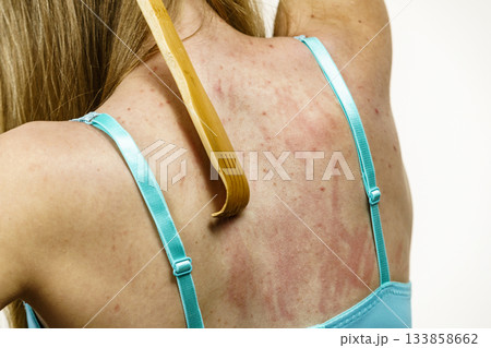 Woman scratching her itchy back using scratcher Woman scratching her itchy back using scratcher 133858662