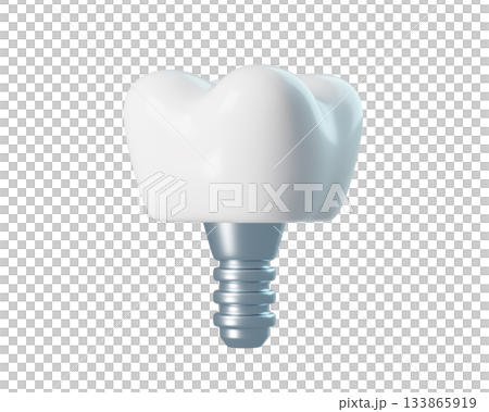 3D Dental Implant with Crown and Screw Post for healthy and orthodontics. 3d rendering 3D Dental Implant with Crown and Screw Post for healthy and orthodontics. 3d rendering 133865919