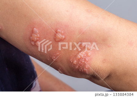 Shingles, Zoster or Herpes Zoster symptoms on arm. 133884384