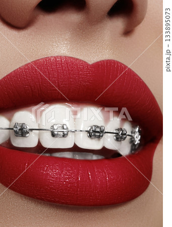 Beautiful white teeth with braces. Dental care photo. Woman smile with ortodontic accessories. Orthodontics treatment Beautiful white teeth with braces. Dental care photo. Woman smile with ortodontic accessories. Orthodontics treatment 133895073