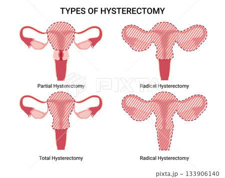 Hysterectomy, surgical removal of the uterus. Vector Medical illustration shows 4 types of hysterectomy: partial, total, radical types. Removal of fallopian tubes, ovary. Hysterectomy, surgical removal of the uterus. Vector Medical illustration shows 4 types of hysterectomy: partial, total, radical types. Removal of fallopian tubes, ovary. 133906140