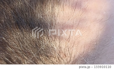 A close-up of hairline texture and growth patterns, highlighting sharp edges. Suitable for medical articles, personal care ads, and cosmetic visuals, focusing on natural detail. A close-up of hairline texture and growth patterns, highlighting sharp edges. Suitable for medical articles, personal care ads, and cosmetic visuals, focusing on natural detail. 133910110