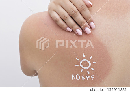 Closeup of red sunburn on shoulder with NO SPF sun symbol in cream, tender skin and UV exposure shown Closeup of red sunburn on shoulder with NO SPF sun symbol in cream, tender skin and UV exposure shown 133911881