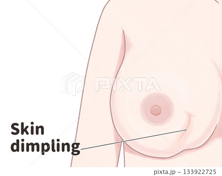 乳がんの症状　くぼみ　引きつれ　わかりやすい英語図解イラスト 133922725