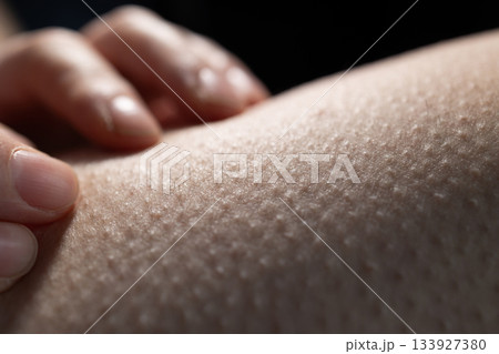 Skin Shows Goosebumps While a Hand Touches It During a Cool Moment in a Dim Setting 133927380