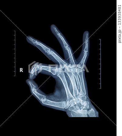 X-ray hand bones OK ring gesture joining the thumb and index finger in a circle X-ray hand bones OK ring gesture joining the thumb and index finger in a circle 133938481