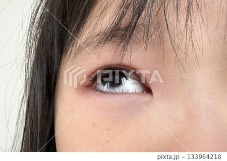 子供のものもらい 133964218