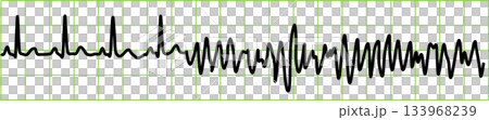 Ventricular fibrillation graphic material illustration Ventricular fibrillation graphic material illustration 133968239