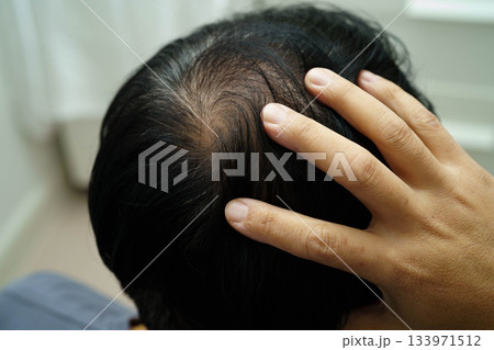 Bald head in man, hair loss treatment health problem. 133971512